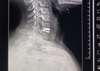 Realizaron el primer reemplazo de disco cervical con prótesis móvil en Villa Mercedes