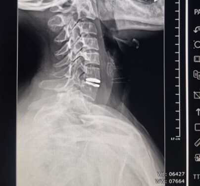 Realizaron el primer reemplazo de disco cervical con prótesis móvil en Villa Mercedes